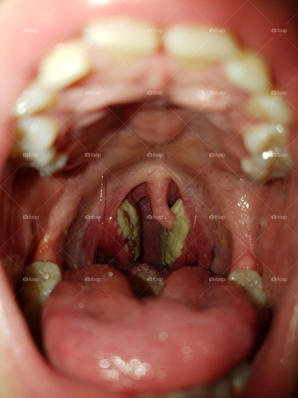Throat strep of photos Throat strep of photos